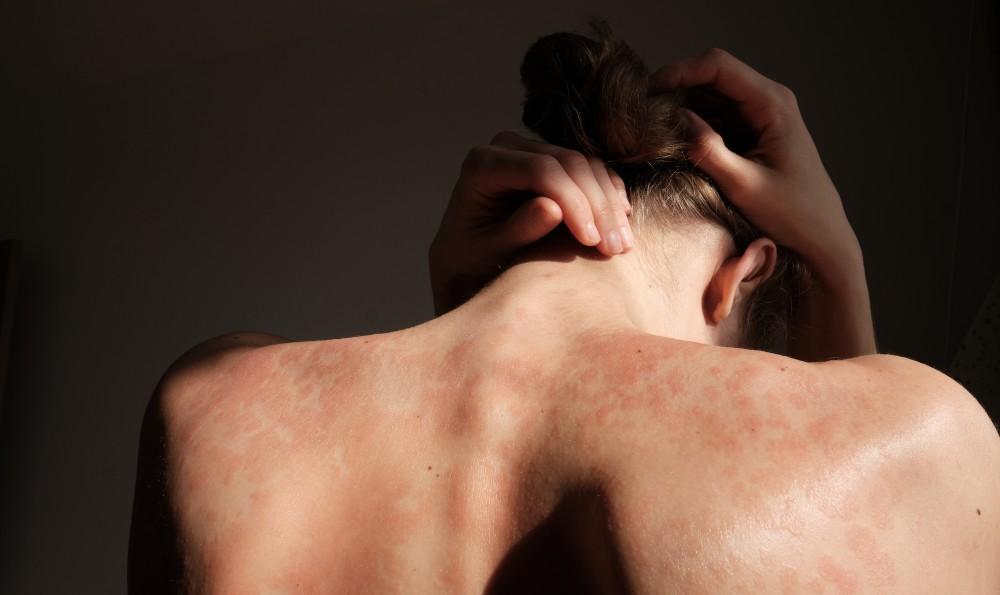 When Does a Skin Rash Warrant Prompt Medical Evaluation? : Orange Coast Dermatology: Medical, Surgical and Cosmetic Dermatology