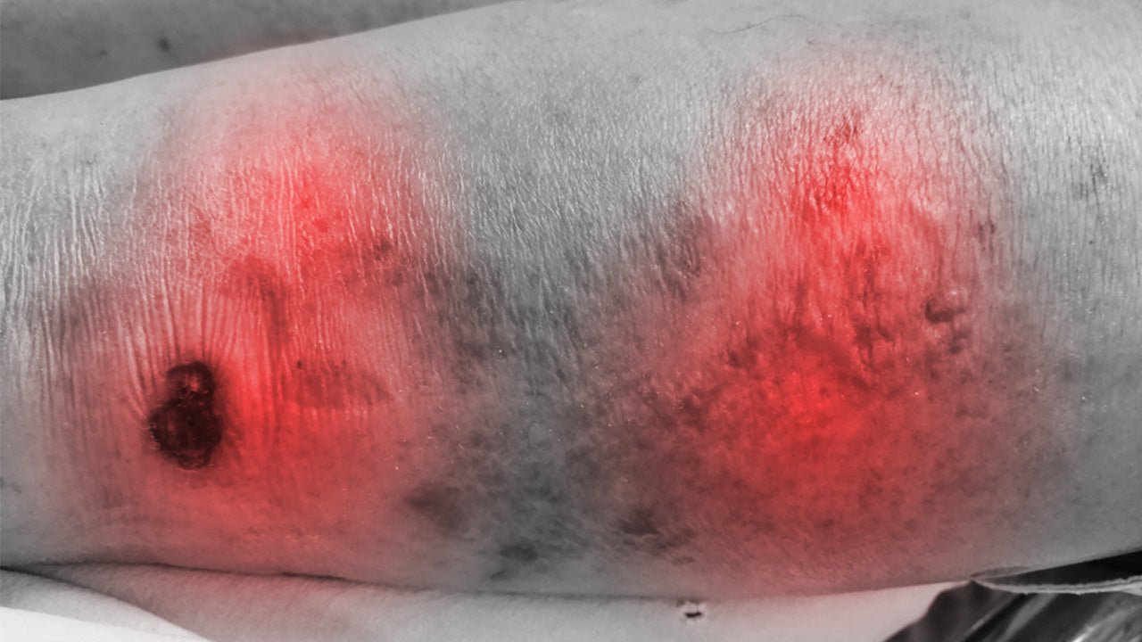Necrotizing Fasciitis: Flesh-Eating Disease Causes, Symptoms, Remedy – The Amino Company