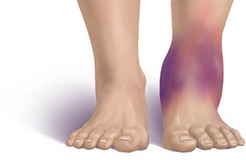 necrotizing-fasciitis-blog-blog on Tumblr